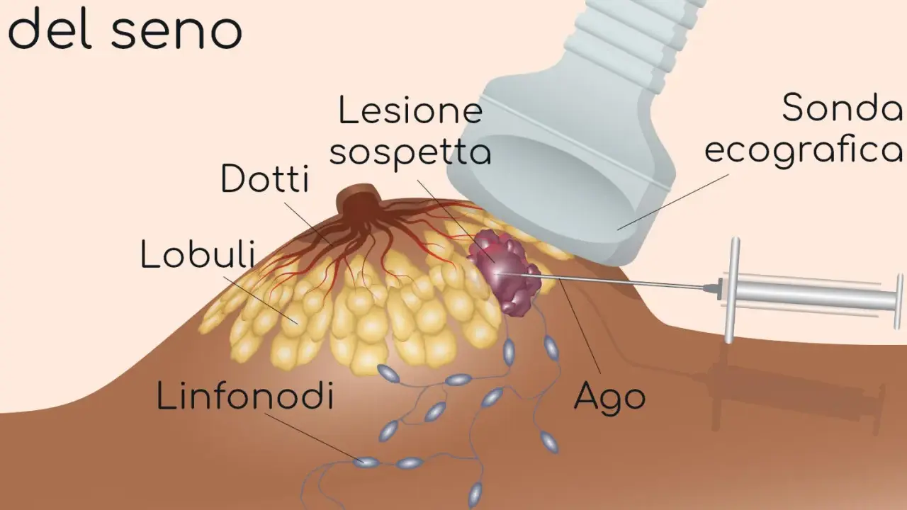 Agobiopsia del seno: un ago guida l'ecografia per prelevare campioni da una lesione sospetta.
