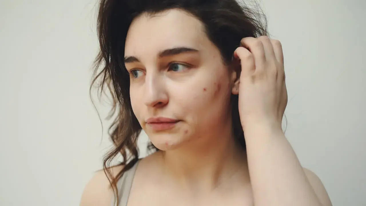 Ragazza con acne sul viso, forse in cerca di informazioni su accutane cos'è per migliorare la sua pelle.