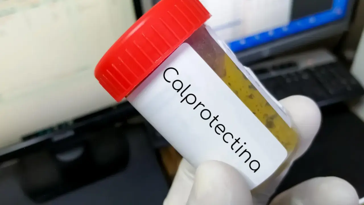 Contenitore con campione fecale etichettato "Calprotectina". Il risultato indica calprotectina fecale alta, suggerendo infiammazione intestinale.