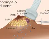 Agobiopsia del seno: un ago guida l'ecografia per prelevare campioni da una lesione sospetta.