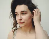 Ragazza con acne sul viso, forse in cerca di informazioni su accutane cos'è per migliorare la sua pelle.