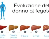 Evoluzione del danno epatico: da fegato sano a fegato grasso, poi fibrosi, cirrosi e infine tumore.