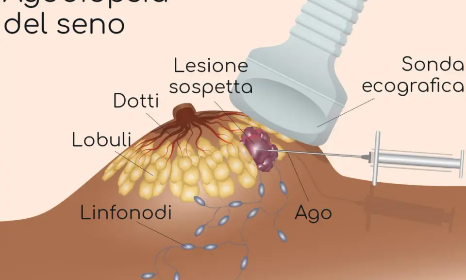 Agobiopsia del seno: un ago guida l'ecografia per prelevare campioni da una lesione sospetta.