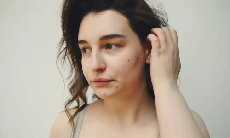 Ragazza con acne sul viso, forse in cerca di informazioni su accutane cos'è per migliorare la sua pelle.