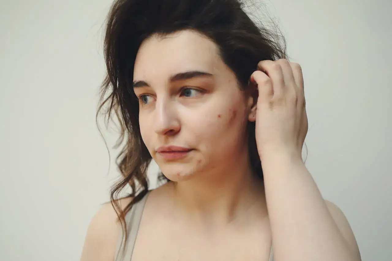 Ragazza con acne sul viso, forse in cerca di informazioni su accutane cos'è per migliorare la sua pelle.