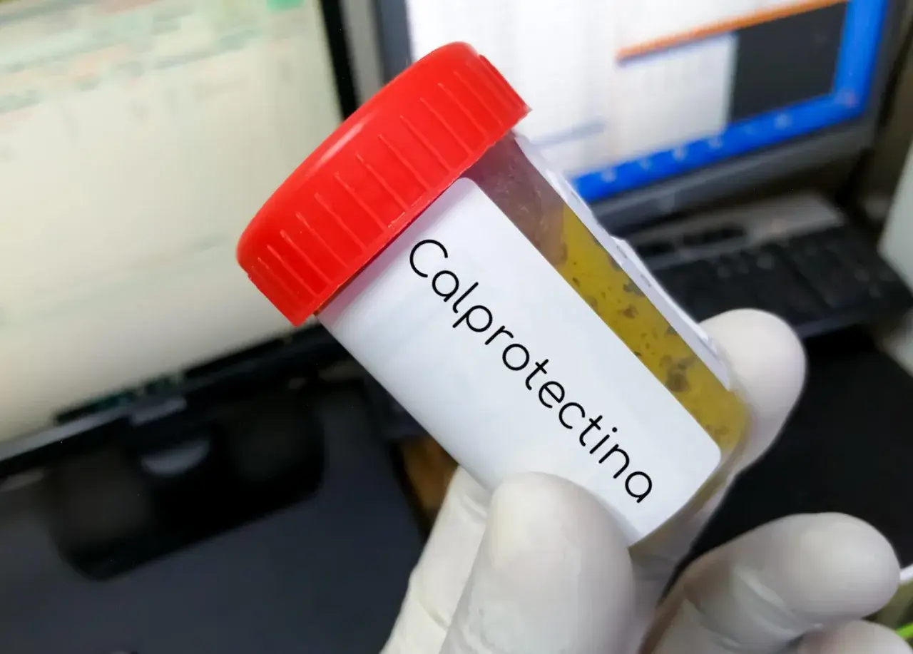 Contenitore con campione fecale etichettato "Calprotectina". Il risultato indica calprotectina fecale alta, suggerendo infiammazione intestinale.