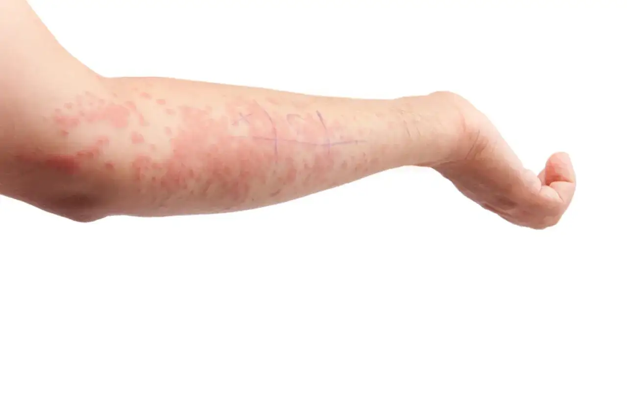Braccio con eruzione cutanea rossa e pruriginosa, forse un effetto collaterale di un antibiotico che fa sudare. Segni a matita viola sulla pelle.