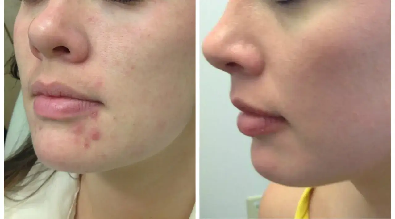 Prima e dopo: il trattamento con Accutane cos'è e come ha migliorato l'acne sul viso di una ragazza, rendendo la pelle più liscia e uniforme.