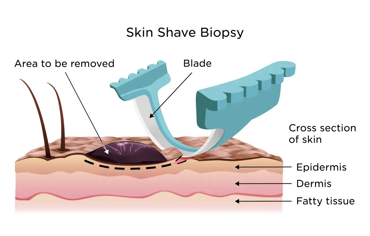 Strumento per biopsia cutanea che rimuove un'area della pelle. Mostra epidermide, derma e tessuto adiposo.