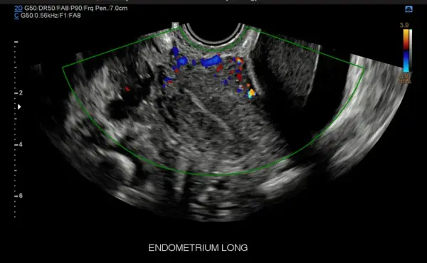 Ecografia pelvica con evidenza di vascolarizzazione anomala, possibile indicatore di tumore ovario.