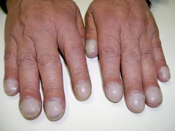 Dita gonfie e unghie arrotondate, segni che possono indicare fibrosi cistica alle mani.
