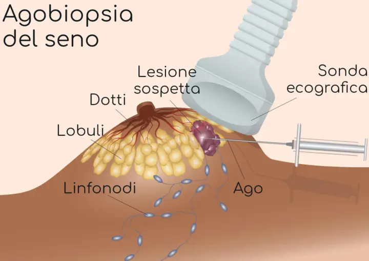 Agobiopsia del seno: un ago guida l'ecografia per prelevare campioni da una lesione sospetta.