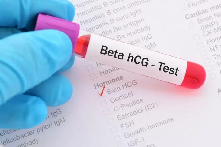 Provette con campione di sangue per test Beta hCG positivo. Il segno di spunta rosso indica il risultato.