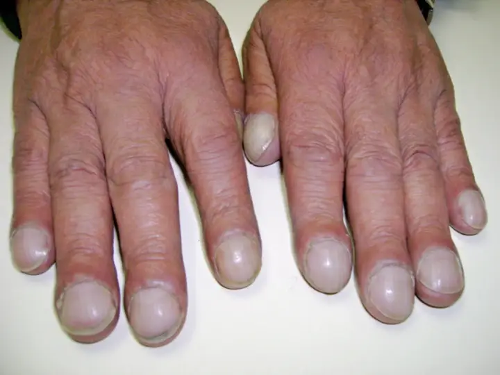 Dita gonfie e unghie arrotondate, segni che possono indicare fibrosi cistica alle mani.